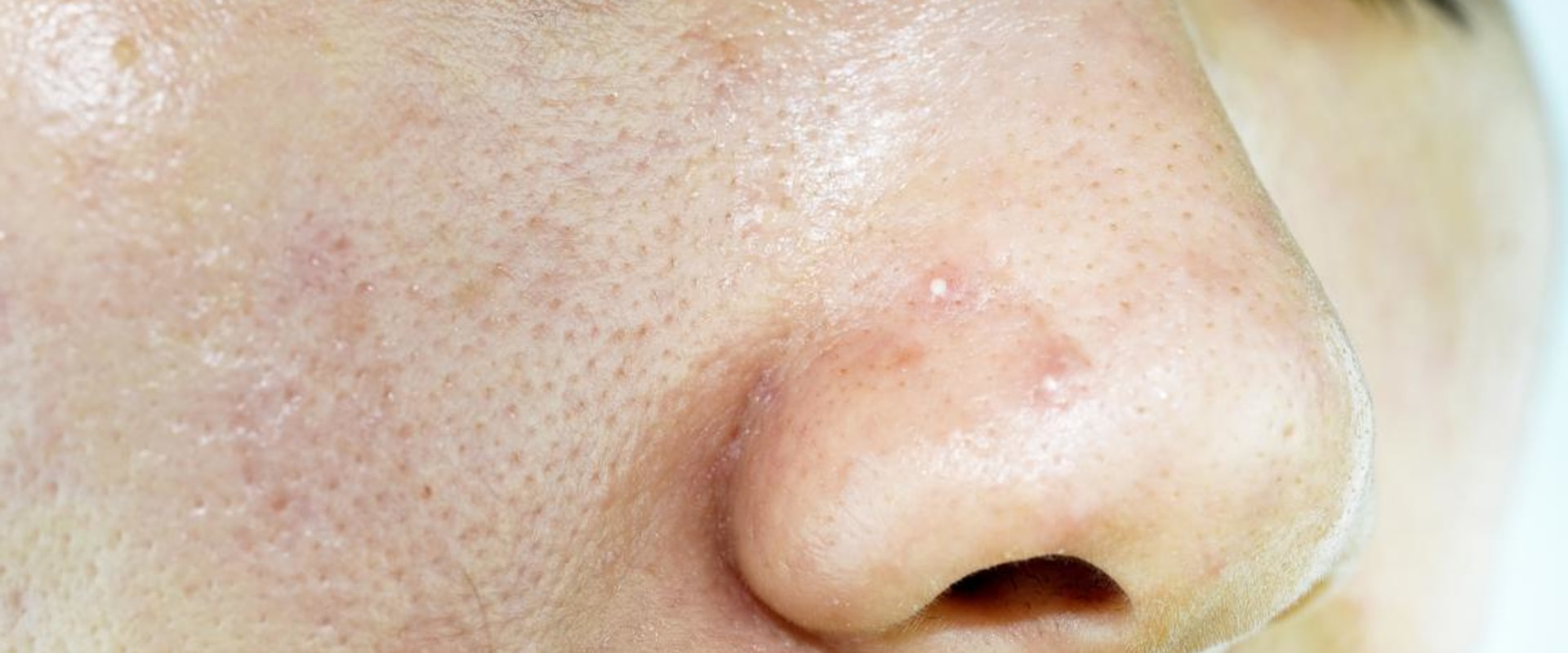 Everything You Need to Know About Oily Skin