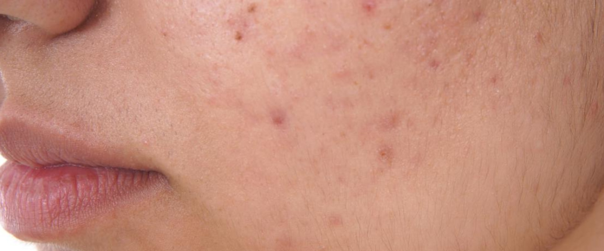 Treating Acne and Problem Areas