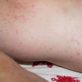 Soothing Rashes and Irritations: A Comprehensive Overview