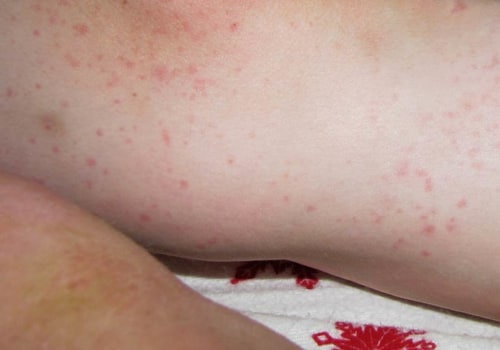 Soothing Rashes and Irritations: A Comprehensive Overview