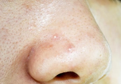 Everything You Need to Know About Oily Skin