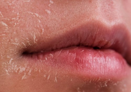 Dry Skin: Everything You Need to Know